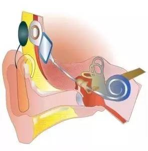 【新闻快递】医院耳鼻喉科成功完成人工电子耳