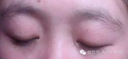 下挂眉形:通过半永久化妆术,将眉部勾画出适合的眉型轮廓,改变眉毛