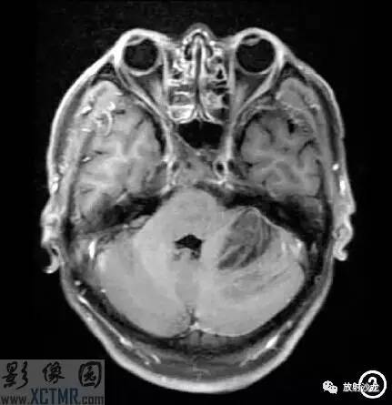 【每日一例 | 382期】左侧小脑半球病变mri病例
