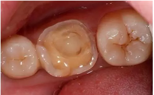 牙齿由龋洞时除了直接补牙,还有其他的方法吗?