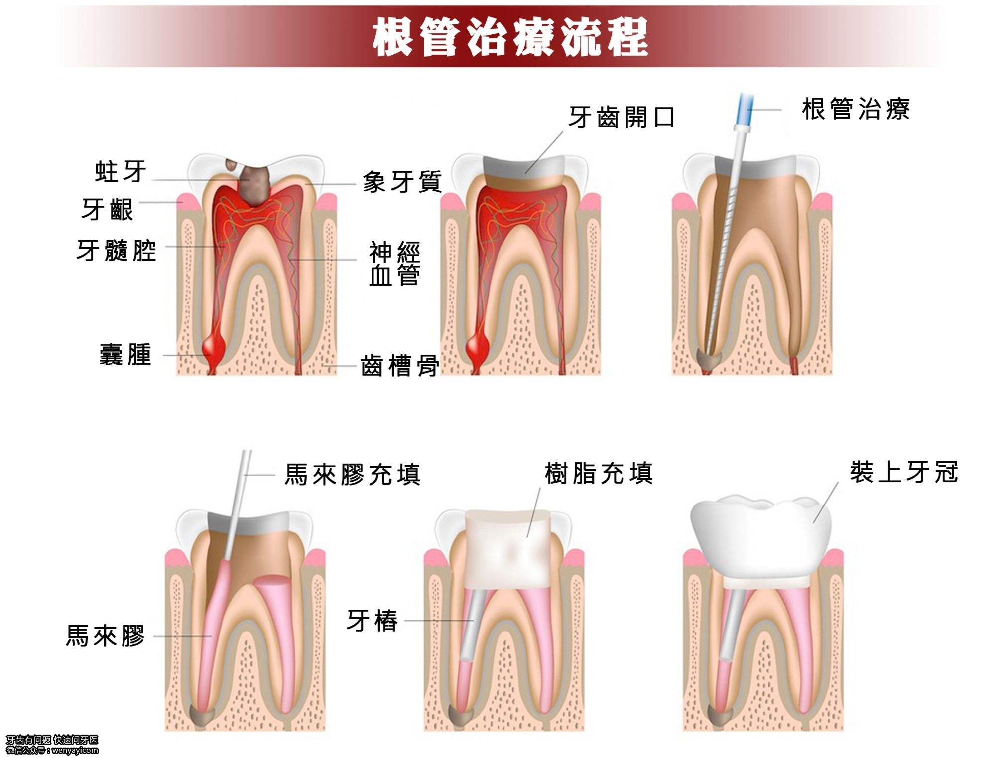 健康 正文 所谓的杀神经,实际就是根管治疗,即通过牙科手机,钻开牙齿