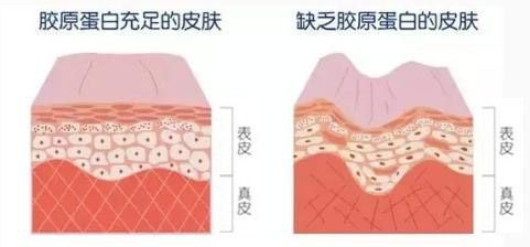 一方面可以加固真皮层的胶原纤维网,承受突然增加的大量脂肪,另一方面