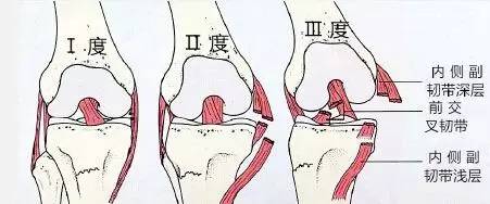 i级通常是前韧带的扭伤