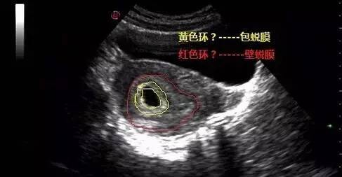 一文看懂早孕超声的三大征象
