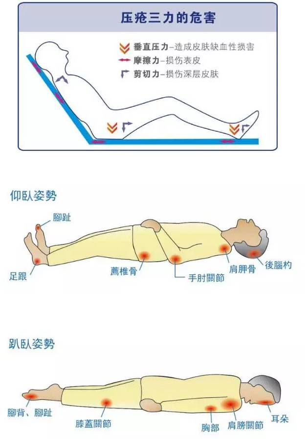 教你几招:预防坐卧位压疮,就这么简单!