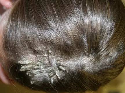 由脂溢性皮炎或银屑病引起,表现为头皮粘着性的皮屑,粘固于近端头发