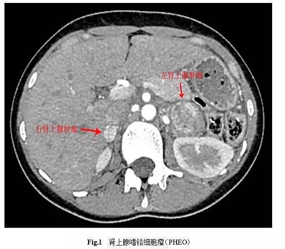 【连载】嗜铬细胞瘤那些事儿