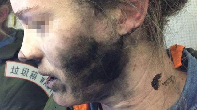 耳机电池起火爆炸,乘客脸部灼伤.
