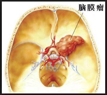 女子手麻竟是脑膜瘤作祟,记住这些警惕脑膜瘤