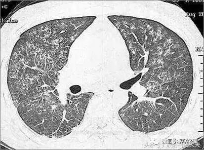 肺ct 表现: 严重的脂肪栓塞综合征患者,主要以弥漫性磨玻璃混浊,小叶