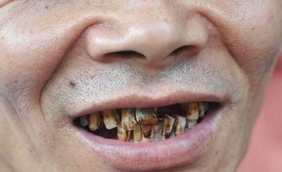 为什么吸烟会对牙齿造成非常大的伤害?
