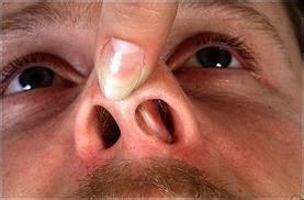 鼻息肉:是鼻腔,鼻窦黏膜的慢性炎性疾病,炎性黏膜高度水肿在鼻腔