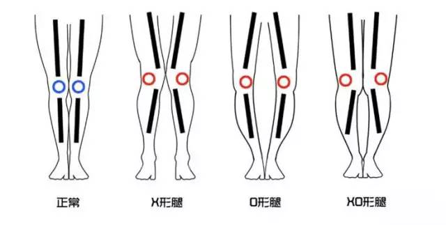 男生腿弯怎么办