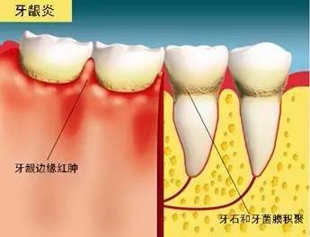 牙齿吃东西出血怎么办