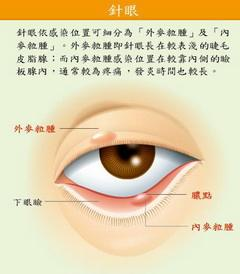 麦粒肿属于眼科疾病,是眼睛受到细菌感染导致的.