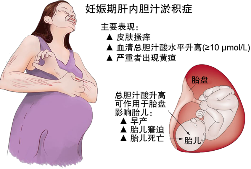 妊娠期肝内胆汁淤积症与乙型肝炎有关吗?