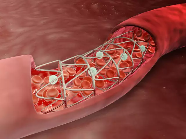 从心脏到大腿动脉血管撕裂的他是这样被救活的