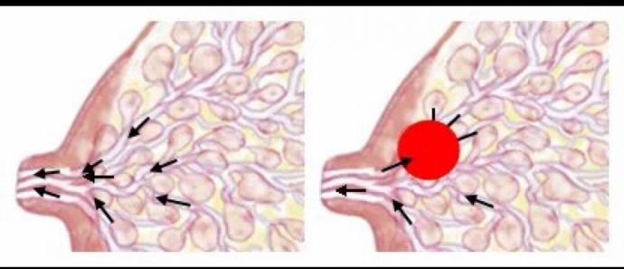 堵奶有硬块怎么办