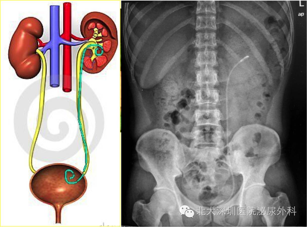 软镜及开放手术)及经皮肾碎石等术后,均常规留置双j管,即输尿管支架管