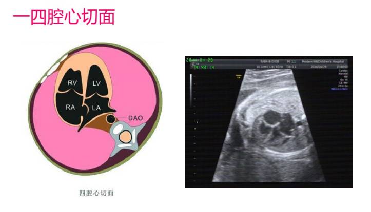 胎儿心脏检查常见切面图