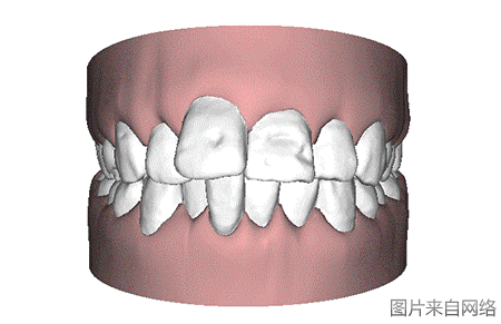 一张图看懂牙齿矫正全过程