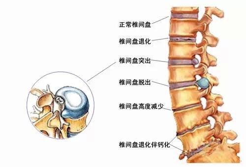 为什么腰间盘突出会导致臀部麻木,大腿疼痛?