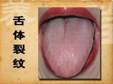 裂纹舌:多伴有舌头表面光红少苔,多为阴液不足,阴伤病人,比如糖尿