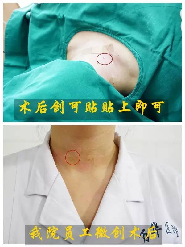 章建全教授来烟台万华医院行甲状腺乳腺超微创手术