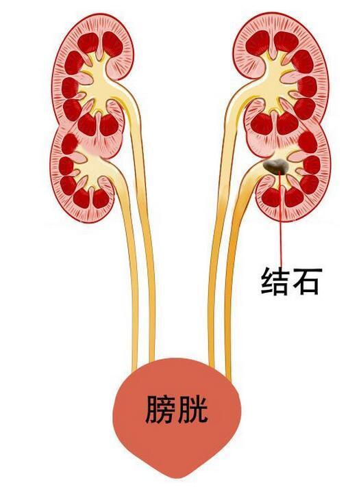 湖北大妈治疗结石 一检查发现有4个肾(组图)