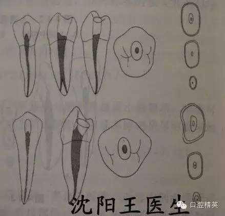 根管数目 个(检出率)    1 ( 70.1% ), 2 ( 29.9% )    1 ( 56.