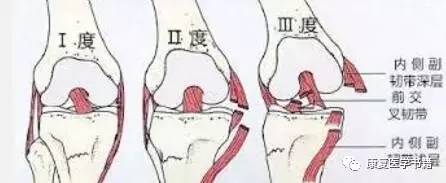 膝内侧副韧带损伤可以分为三个等级, 第一级:有受伤但韧带没有断裂
