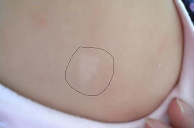 在新生的宝宝身上,有时会看到有白色的胎记,在医学上我们称之为色素