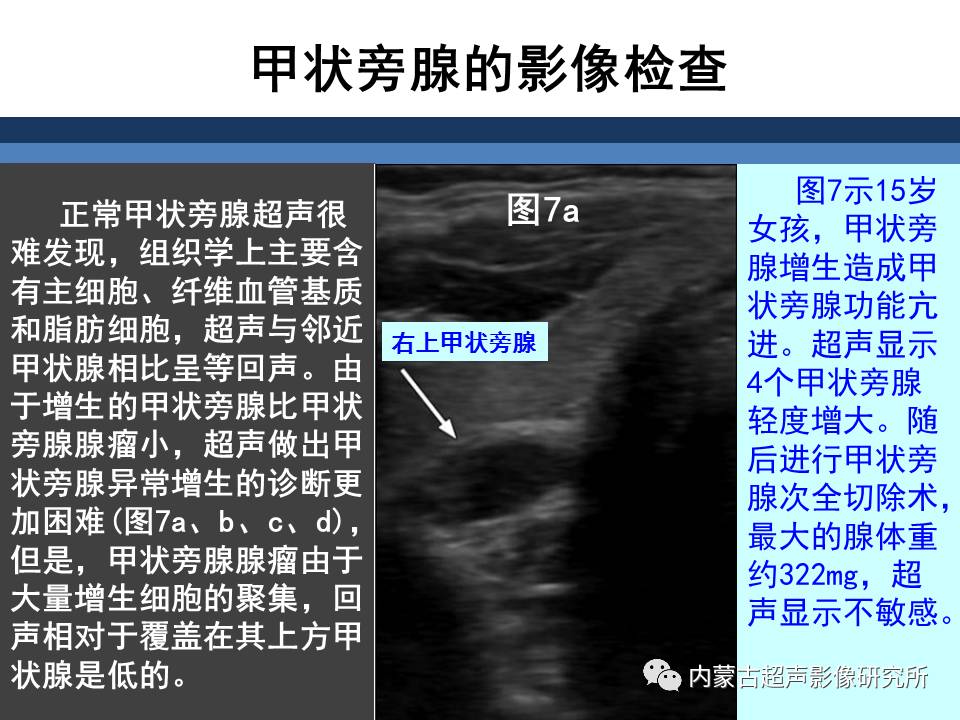 原发性甲状旁腺功能亢进的术前影像评价