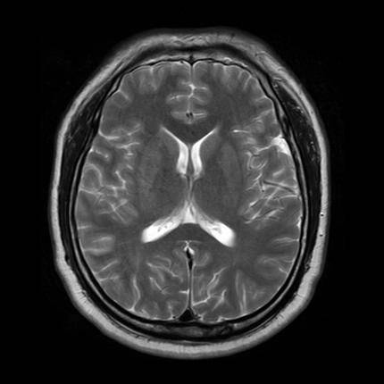 脑梗死的5大ct征象