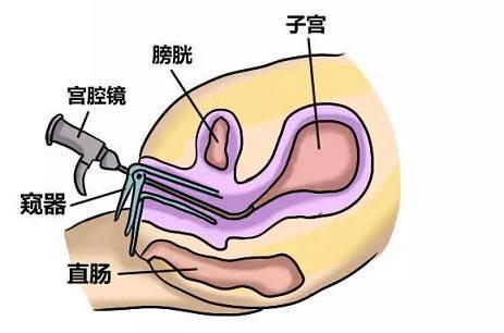 造人须得子宫强,那宫腔粘连如何诊治?