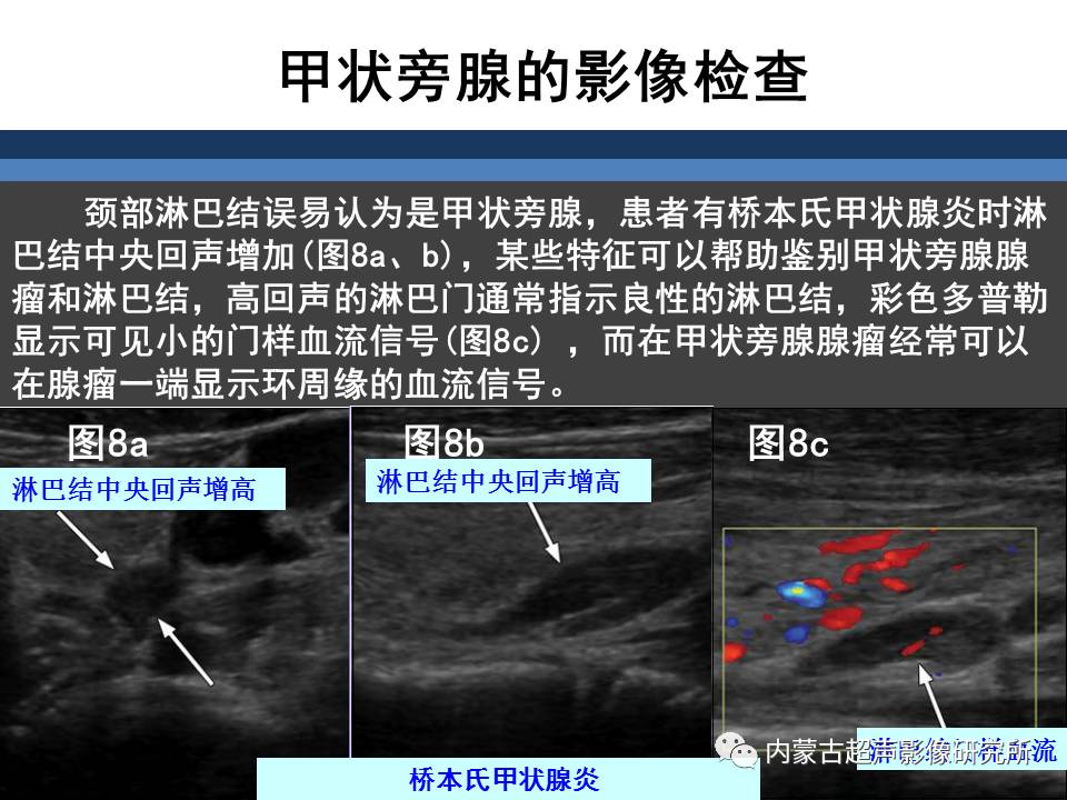 原发性甲状旁腺功能亢进的术前影像评价