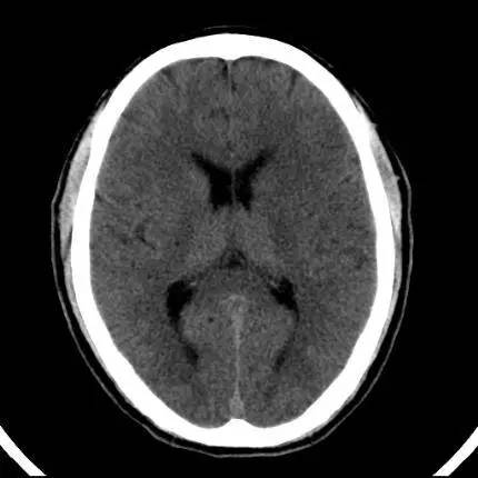 脑梗死的5大CT征象