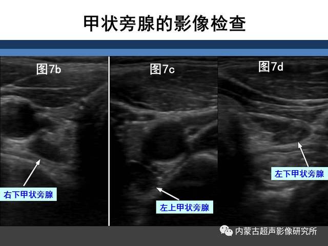 原发性甲状旁腺功能亢进的术前影像评价