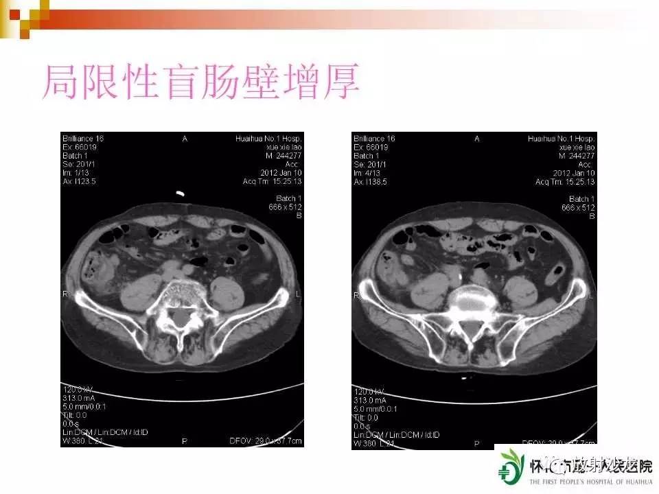 经典总结 | 急性阑尾炎的ct诊断