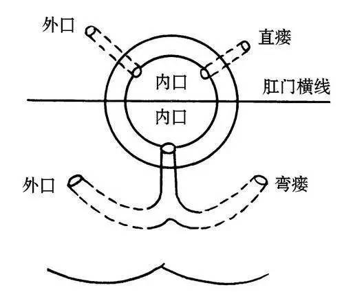 肛管括约肌外型:约占1,多由骨盆直肠间隙脓肿合并坐骨肛管间隙