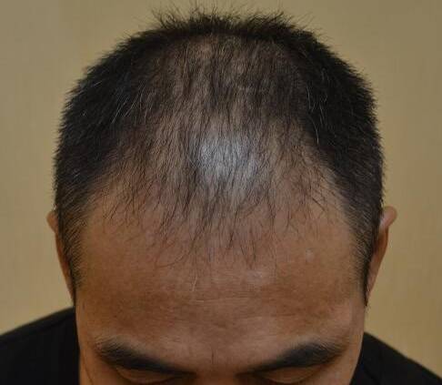 图为头发种植前的王小川(化)头顶大面积稀疏