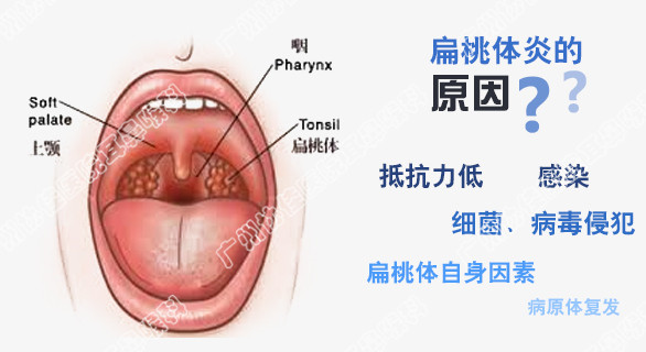 鸭梨等时令水果,一定程度上能缓解病痛,但对病情较重的扁桃体炎作用不