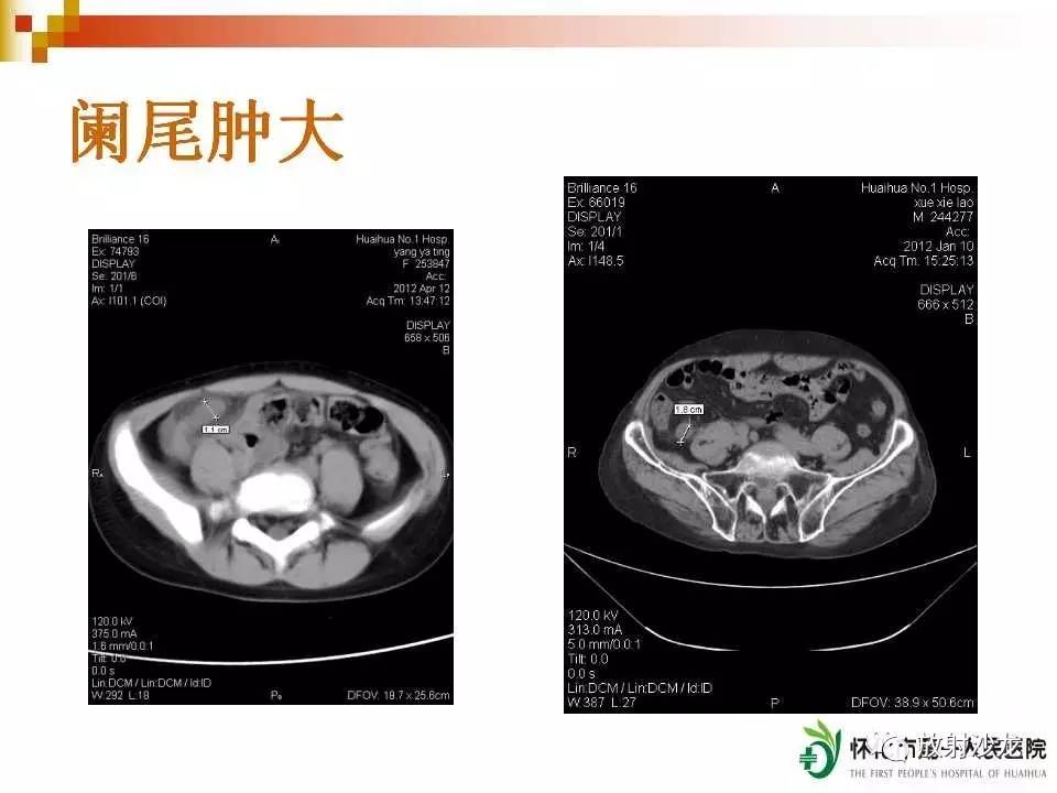 经典总结 | 急性阑尾炎的ct诊断