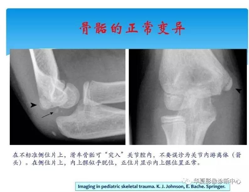 儿童肘关节骨化中心生理及变异