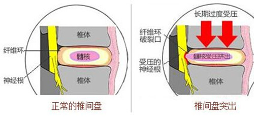 骨巨细胞瘤,脊索瘤,脊髓及神经根肿瘤,胰腺癌,盆腔肿瘤等;3,炎症:脊柱