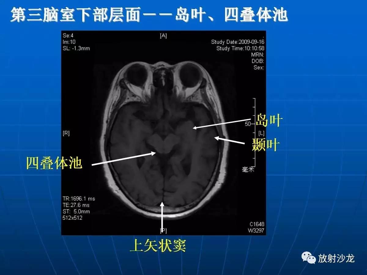 基础必备脑部磁共振呈像