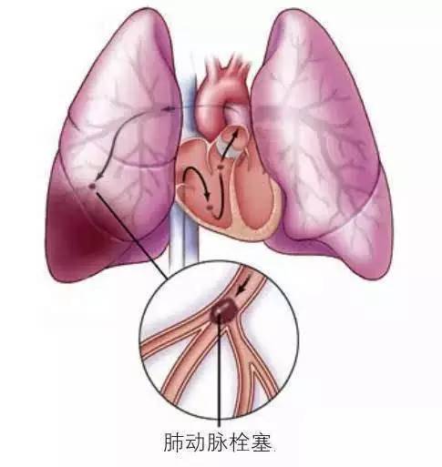 肺栓塞肺部的血管堵了04动脉堵塞严重时可能导致腿脚缺血坏死