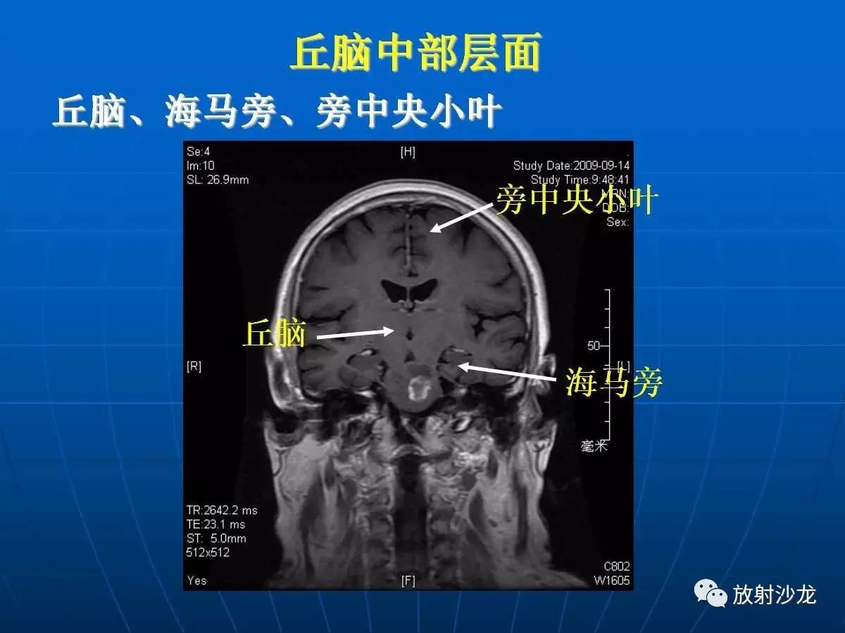 基础必备脑部磁共振呈像