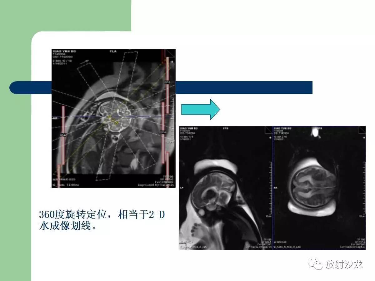 收藏| 胎儿核磁共振成像技术