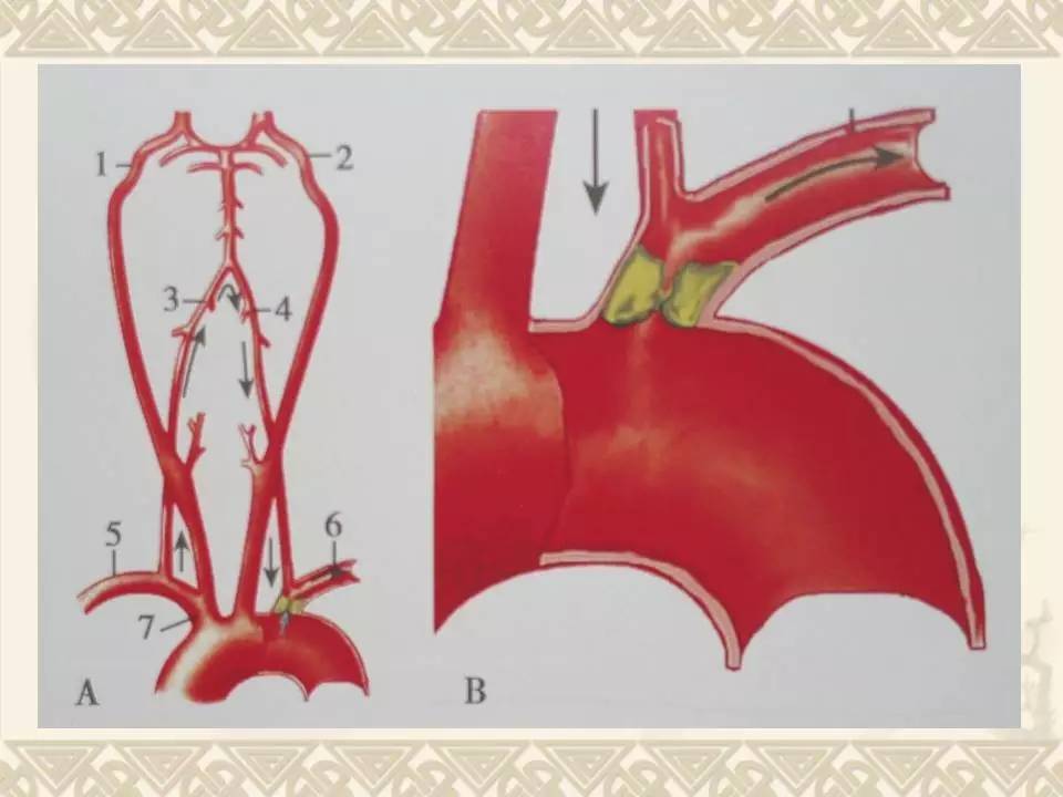 颈动脉及椎动脉超声诊断